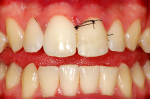 Figure 15 Tooth after the reattachment of the dental fragments and the suture of periodontal surgery.