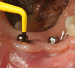 Figure 5 Clinical aspect and probing, implant No. 20, after 15 months follow-up.