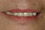 Figure 3. Patient’s preoperative frontal smile view. Note patient’s low smile line.