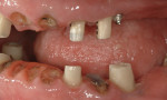 Figure 9. Lateral views of provisional abutments placed and one remaining tooth to support the second phase of provisional restorations. Most of the teeth were ground to the gingival level prior to the second phase of implant placement and extractions.