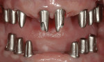 Figure 16. Frontal intraoral view of titanium-milled individual abutments trying-in.