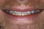 Figure 4. The full smile showed an aberrant incisal plane that did not follow smile design principles.