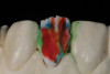 Fig 7. Resin build-up accomplished for palatal surfaces to restore lost form.