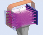 Figure 2 S-Ray technology places ultrsound sending and receiving units on either side of the teeth.
