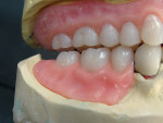 Figure 9 Right posterior interocclusal space after the occlusal record has been removed.