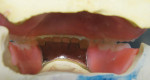Figure 14 Occlusal view of interocclusal space before requested reset Curve of Spee changes.