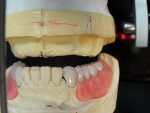 Figure 13 View of the maxillary complete denture working space for tooth arrangement. The vertical red line is the existing length of centrals, and the blue line is a reference for raising the anteriors by 1 mm.