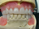 Figure 20 Occlusal view of the maxillary complete denture showing lingualized cusps contacts and no anterior contact in centric occlusion.