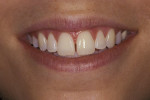 Figure 3  The smile of a female patient with a diastema between central incisors