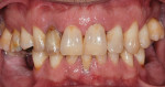 Figure 1 Pretreatment condition of the natural dentition.
