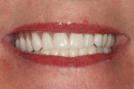 Figure 12 A natural smile and restored occlusion.