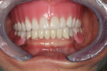 Figure 10 Wax denture and partial at final try in appointment.