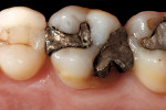 Figure 1  Fractured disto-palatal cusp of tooth No. 14 with a large DOL amalgam restoration.