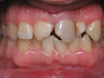 Figure 11 - This patient presented with crowding and fractured teeth due to trauma. Orthodontics were performed to correct crowding, and internal bleaching was done on tooth No. 9 and laminates were placed on teeth Nos. 8 and 9.