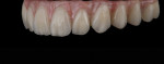 Figure 13 The final acrylic fixed hybrid denture is gingiva-tinted with anaxdent’s Acryline kit.