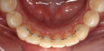 Figure 6 - Because the patient was a class 2 orthodontic patient with sufficient maxillary space, she could wear a fixed lingual retainer.
