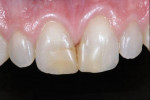 Figure 1 - Preoperative view of a patient with discoloration on teeth Nos. 7 and 8 who would receive conservative composite restorations using a simplified composite system.