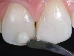 Figure 2 - A single shade/layer of composite was precisely placed and sculpted onto the minimal tooth preparations. (3.) View of the highly esthetic, chameleon single-shade, direct composite restorations.