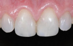 Figure 3 - View of the highly esthetic, chameleon single-shade, direct composite restorations.