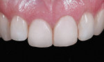Figure 6 - View of the completed anterior multiple-composite–shade restorations that demonstrate enhanced color and harmony.