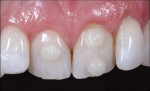 Figure 5 - Composite shades were previewed on the teeth to determine the appropriate cervical, body, and incisal composite shades.