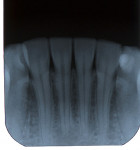 Figure 5   Trauma-related TAB of lower right central incisor. Note color change of incisor (Fig 4). Radiograph of same tooth exhibiting apical surface root resorption with apical pulp obliteration (Fig 5).