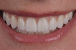 Figure 4 Thin veneers (eg, 0.2 mm) over nice underlying tooth color.