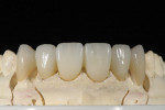 Figure 11 Thin facial layering provides translucency, while full lingual contour zirconia provides durability.