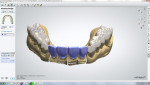 Figure 21 Digital design used to create bite opening provisional restorations overlaying posterior teeth. Restorations were milled from PMMA.