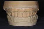 Figure 6. Study cast of mock-up showing corrections desired in gingival levels of teeth Nos. 4 through 13.