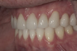 Figure 11 through Figure 13. Natural-appearing restorations had predictable interproximal contacts at cementation—left lateral view (Fig 12).