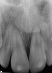 Figure 7. Post-replantation periapical radiograph showing repositioning of tooth No. 9 in alveolar socket.