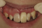 Figure 3 and Figure 4. Intraoral photographs taken at initial presentation (10 days post-trauma).