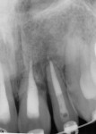 Figure 18 through Figure 20. At 2 years and 15 weeks post-trauma, periapical radiographs (Fig 18 and Fig 19) showed active orthodontic tooth movement, moderate-to-severe external root resorption, and a horizontal root fracture on tooth No. 9; the intraoral photograph (Fig 20) showed active orthodontic tooth movement.