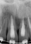 Figure 18 through Figure 20. At 2 years and 15 weeks post-trauma, periapical radiographs (Fig 18 and Fig 19) showed active orthodontic tooth movement, moderate-to-severe external root resorption, and a horizontal root fracture on tooth No. 9; the intraoral photograph (Fig 20) showed active orthodontic tooth movement.