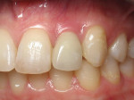 Figure 2  Clinical photograph of an implant restoration replacing the congenitally missing maxillary left lateral incisor. Note the cyanotic color changes, due to inflammation and cement, of the marginal gingiva in a 31-year-old female patient with t