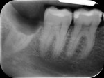 Figure 6 Periapical radiographs
were taken before suturing.