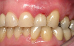 Figure 3  Clinical photograph of maxillary left lateral incisor implant restoration in a 60-year-old man. Implant had been restored 5 years earlier. The thick gingival tissue demonstrated redness and cyanotic color changes, swollen marginal contour,