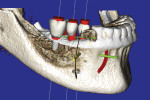 Figure 3 CBCT 3-D volumetric rendering illustrating three implants and three virtual teeth.
