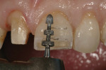 Figure 7 The second phase utilizes the gingival depth-cutting diamond tip of the bur.