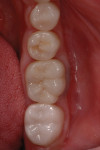 Figure 1 Full-mouth rehabilitation on severe bruxer at 4.5 years. Lava full-contour crown on second molar polished with Dialite System. e.max crowns on molar and premolars.