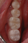 Figure 3 Full-mouth rehabilitation on severe bruxer at 4.5 years. Lava full-contour crown on second molar polished with Dialite System. e.max crowns on molar and premolars.