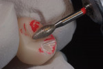 Figure 5 Adjustment of occlusion on full-contour zirconia crown using football-shaped Dialite Double Red-Band Finishing Diamond.