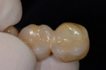 Figure 4 Exposed area of zirconia substructure on palatal cusp of second molar. Note how zirconia is polished to a higher luster than veneering porcelain.