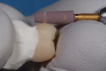 Figure 9 Gross adjustment of lithium disilicate with Dialite LD Grinder.