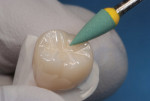 Figure 17 Dialite ZR green Medium Fine
polishing point for crafting a shine in the occlusal grooves.