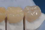 Figure 21 Completed full-contour zirconia crown No. 18 and lithium disilicate crown No. 19.