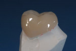 Figure 22 Completed full-contour zirconia crown No. 20 with durable high shine and luster.
