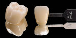 Figure 23 The new Lava Plus All-Zirconia Monolithic system achieves esthetic results that match the Vita Shade Guide.