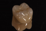 Figure 25 Lava Plus monolithic translucent zirconia crown differentially colored with incisal and dentin internally then polished with Dialite ZR system.